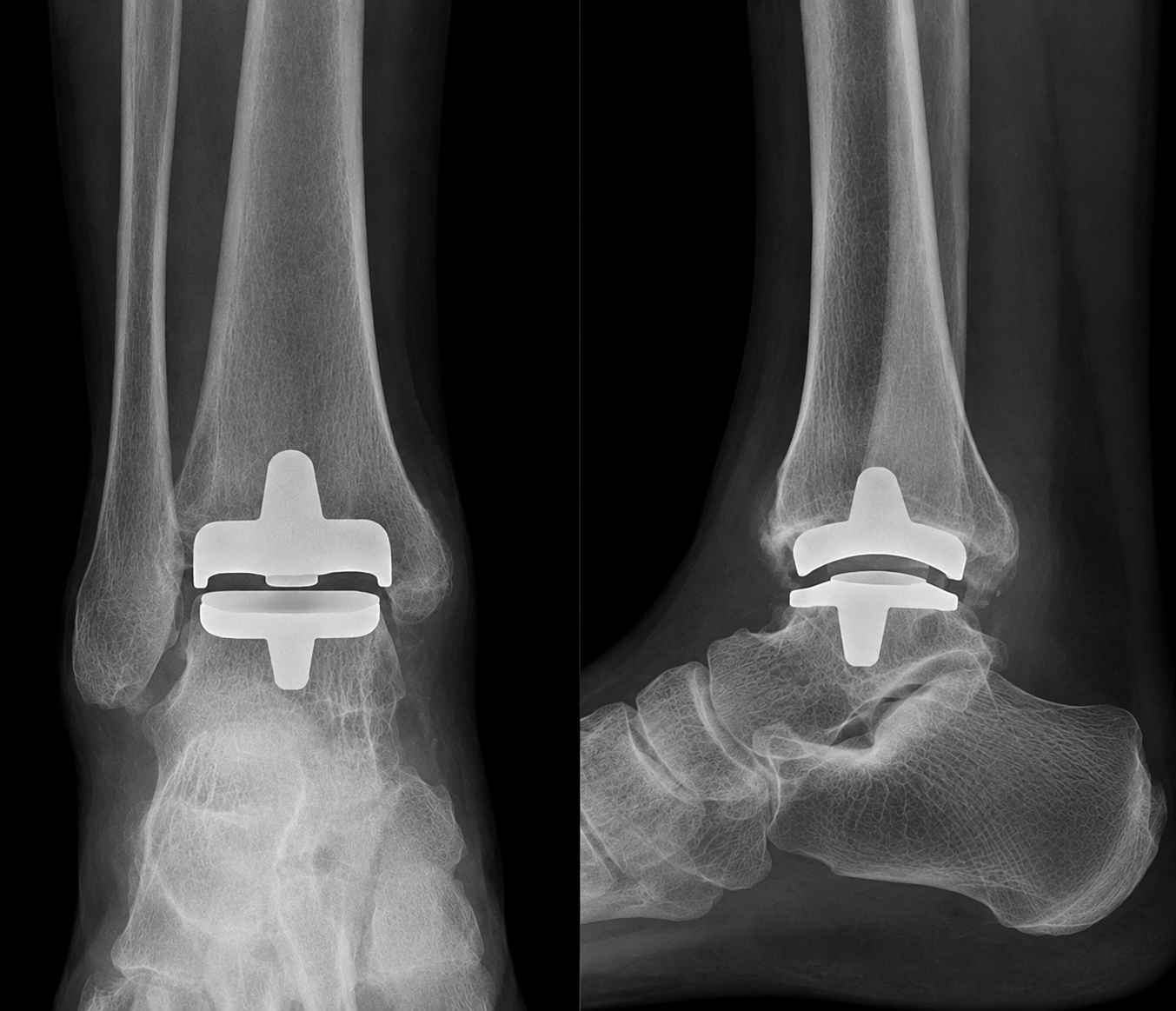 X-ray of a total ankle replacement in situ showing the metal tibial and talar components with a polyethylene bearing.