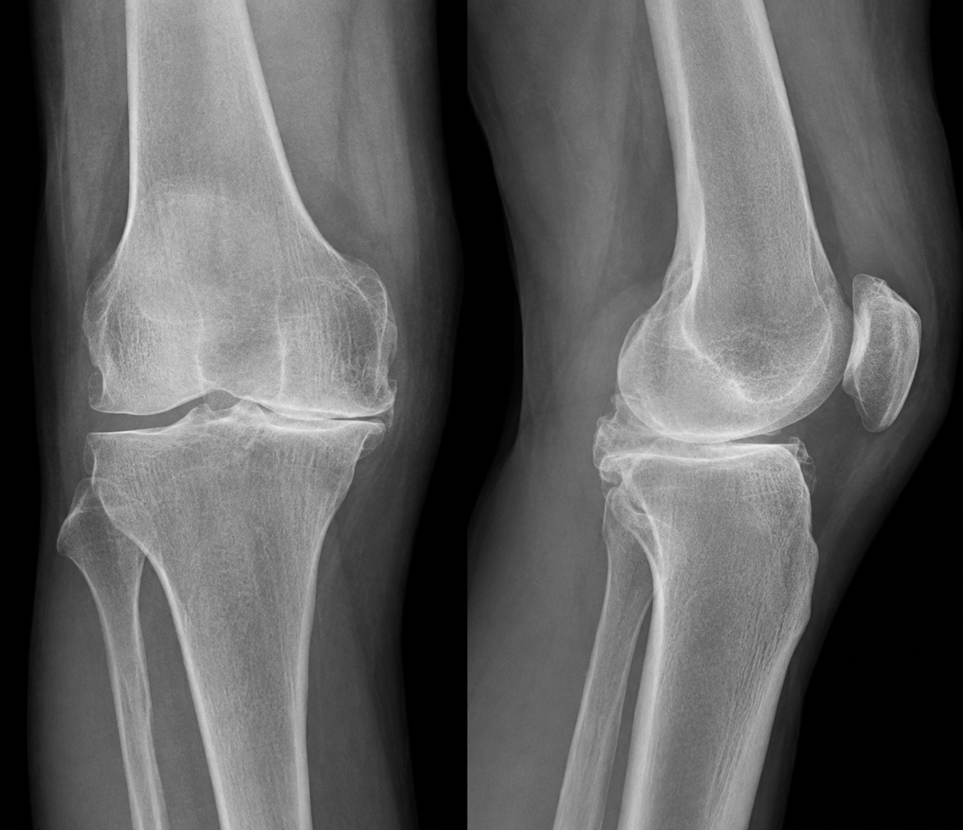 Weight-bearing X-rays of a knee, front and side views