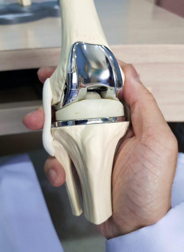 A hand holding an anatomical model of a knee with a total knee replacement implant in place.