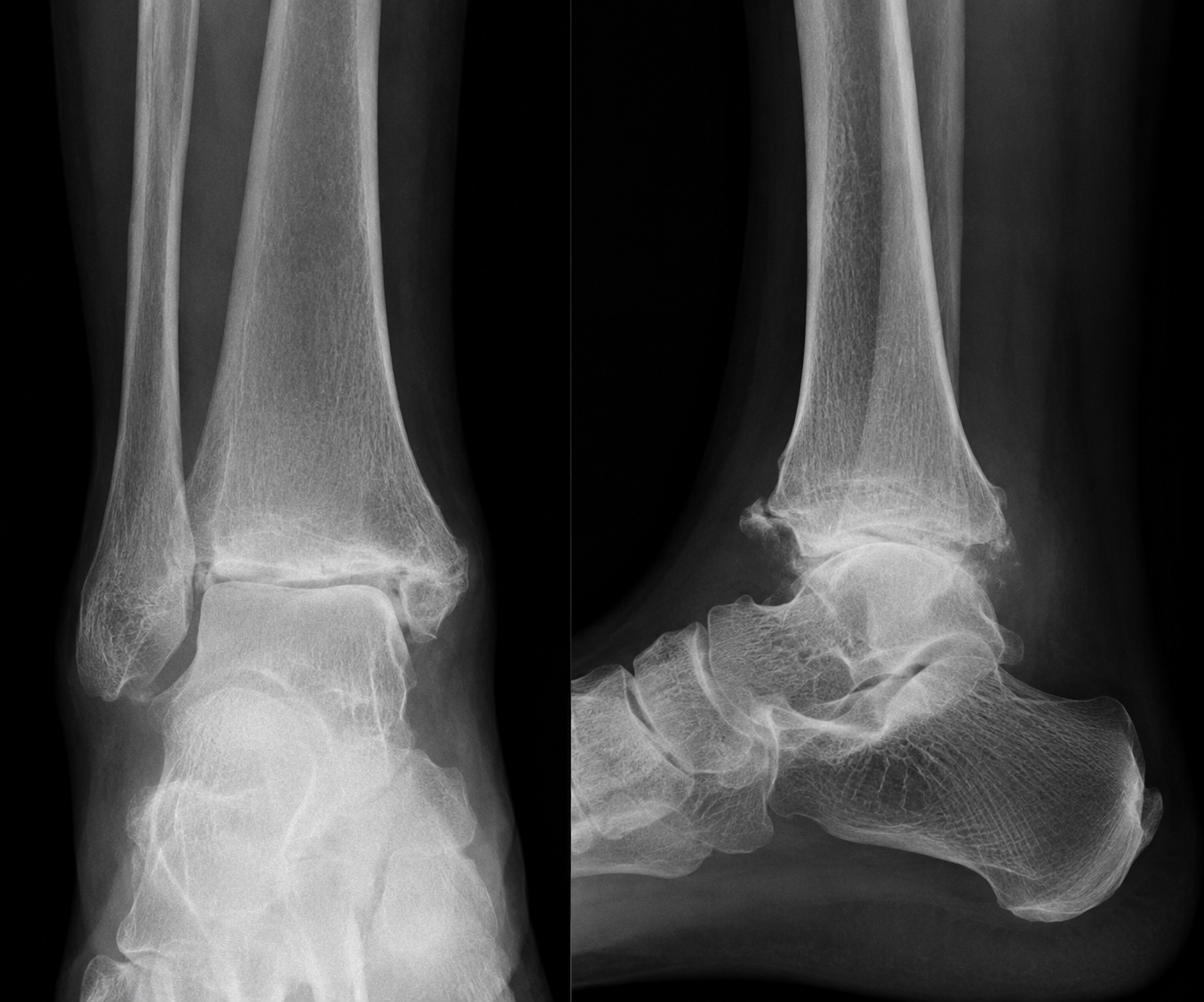Weight-bearing X-ray of an arthritic ankle showing joint space narrowing, bone spurs and sclerosis.