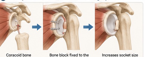 Three-step illustration of the Latarjet procedure: the coracoid bone is taken, fixed to the front of the glenoid, and increases socket size.