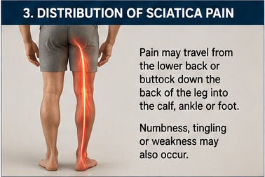Illustration showing sciatica pain travelling from the lower back and buttock down the back of the leg into the calf and foot.