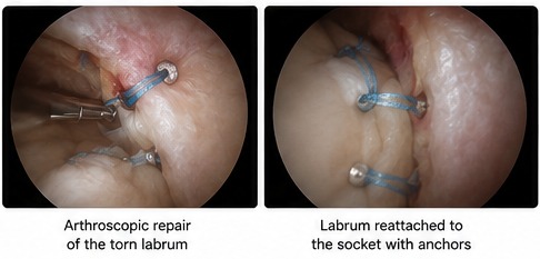 Two arthroscopic views of the shoulder showing the torn labrum being repaired and then reattached to the socket with suture anchors.