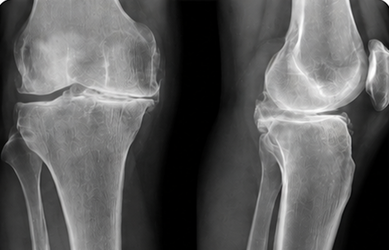X-ray of an arthritic knee joint.