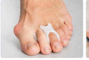 A silicone toe spacer placed between the big toe and second toe.