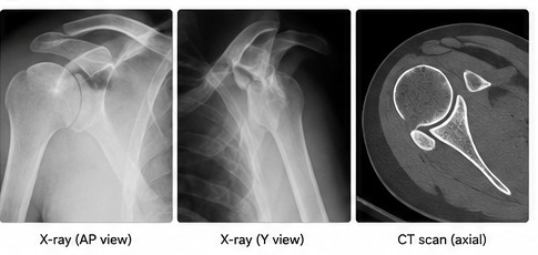 Three images side by side: an AP shoulder X-ray, a Y-view X-ray and an axial CT scan of the shoulder.