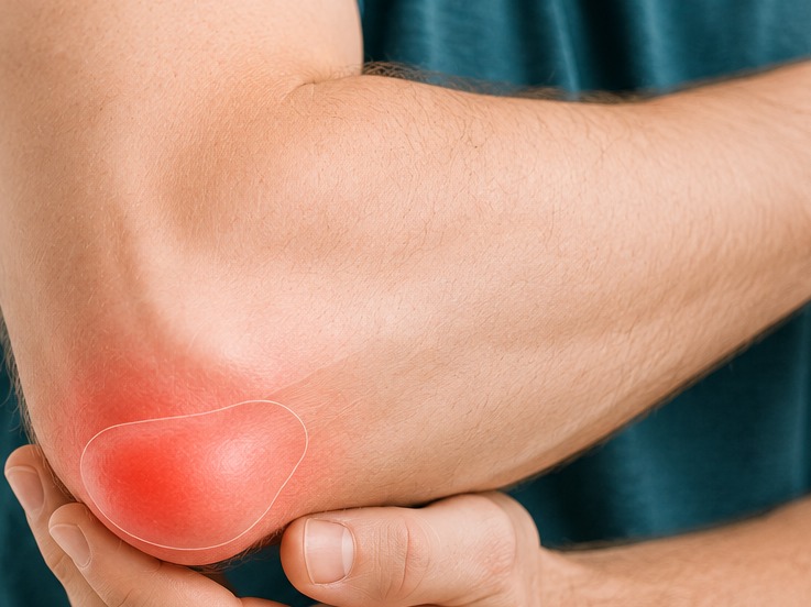 A person supporting the back of a swollen elbow with the olecranon bursa highlighted in red.
