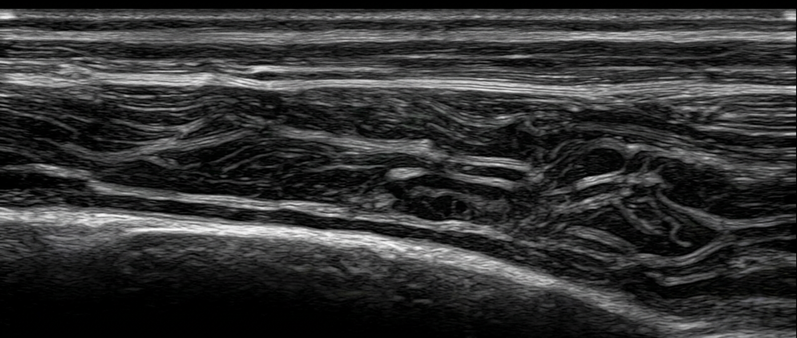 An ultrasound scan image of the Achilles tendon.