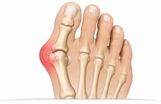 Medical illustration of the bones of the forefoot showing the big toe angled towards the second toe with an inflamed joint.