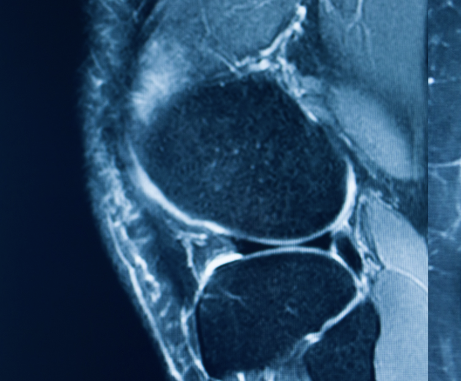 Sagittal MRI scan of the knee showing the menisci and joint structures.