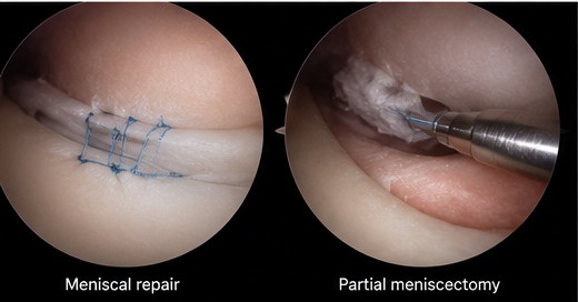 Arthroscopic views of a meniscal repair with sutures alongside a partial meniscectomy being trimmed with an instrument.