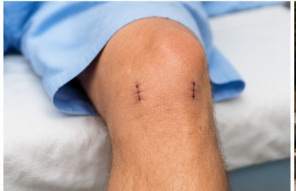 Close-up of a knee after keyhole surgery showing two small sutured arthroscopy incisions.