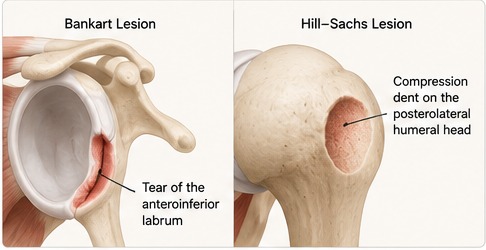 Illustrations of a Bankart lesion showing a tear of the anteroinferior labrum, and a Hill-Sachs lesion showing a compression dent on the posterolateral humeral head.