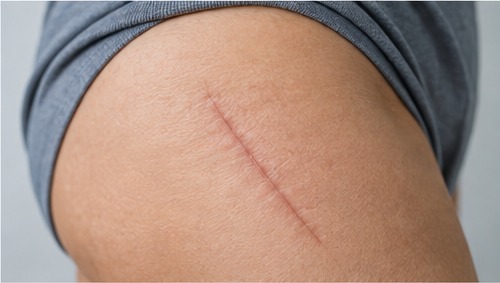A healed surgical scar on the outer aspect of a thigh after hip replacement surgery.