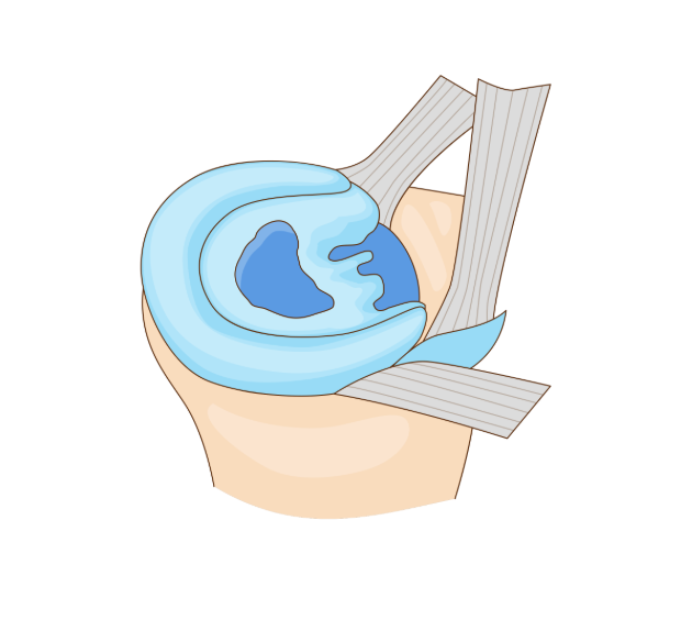 Illustration of a meniscus tear pattern within the knee joint.