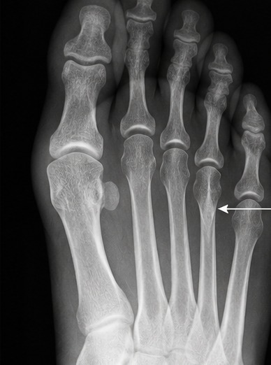 X-ray of a forefoot showing narrowed spaces between the metatarsal heads.